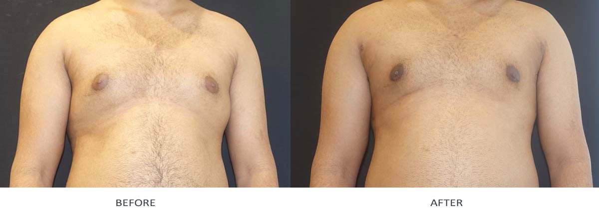 Gynaecomastia (Male Breast Reduction) | Dr. Adam Najem