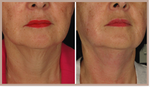 Ultraformer III - Non-Surgical Skin Tightening